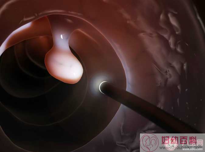 宫颈息肉会影响女性怀孕吗 日常如何预防宫颈息肉