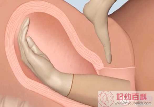 手剥胎盘是用手进去撕吗 为什么有些产妇需要手剥胎盘