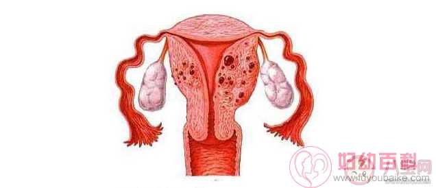 子宫肌瘤和子宫腺肌瘤有什么区别 子宫肌瘤和子宫腺肌瘤一样吗
