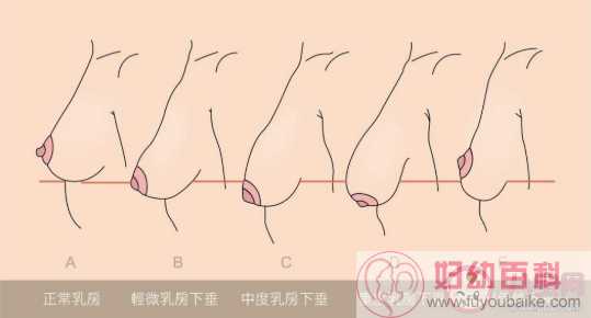 真正的乳房下垂是什么样的 怎么区分真正的乳房下垂