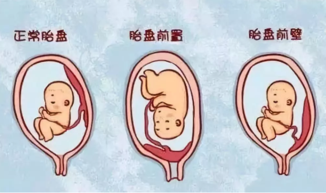 胎盘前置和胎盘前壁是一回事吗 孕期发生胎盘前置怎么办