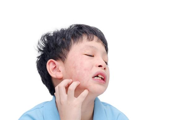 怎么区分荨麻疹和湿疹 小儿荨麻疹能治愈吗