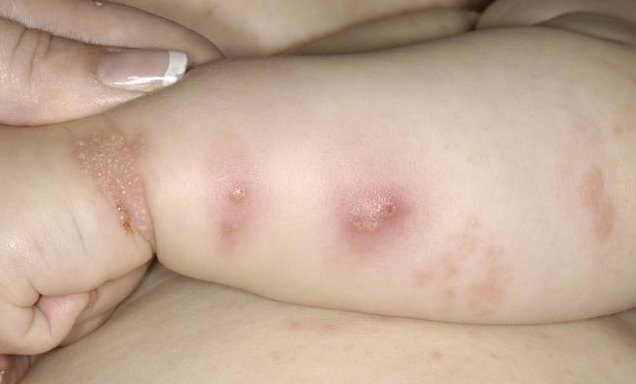 如何预防春季孩子长水痘 春季孩子长水痘的护理方法