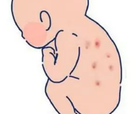 新生儿红斑会自己好吗 刚出生的宝宝长红斑怎么回事
