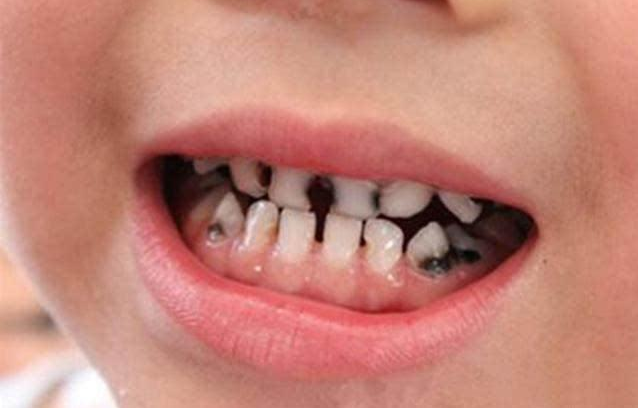 乳牙龋病需要治疗吗 0~3岁宝宝刷牙指南
