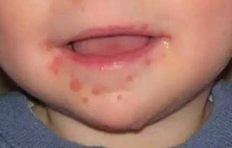 宝宝嘴巴周围起红疹是怎么回事 宝宝嘴巴周围长红疹怎么办
