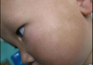 孩子白色糠疹是怎么回事 引起白色糠疹的原因