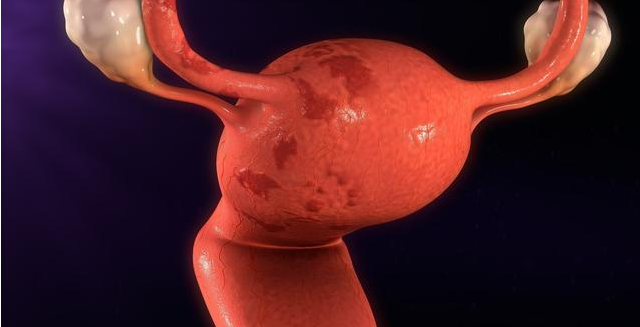 子宫内膜癌的危害有哪些 子宫内膜癌治疗方法