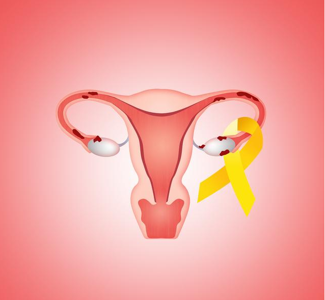 子宫内膜癌的危害有哪些 子宫内膜癌治疗方法