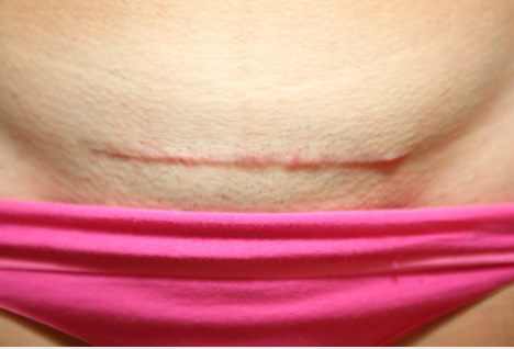 疤痕体质的孕妇剖腹产是怎样的体验 疤痕体质有多可怕