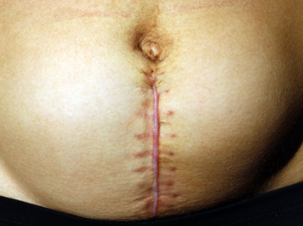 疤痕体质的孕妇剖腹产是怎样的体验 疤痕体质有多可怕