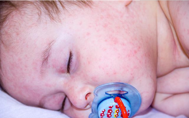 为什么春季宝宝容易得湿疹 如何预防春天孩子长湿疹