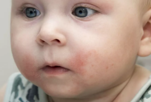 孩子湿疹不能吃什么 孩子湿疹要少吃什么