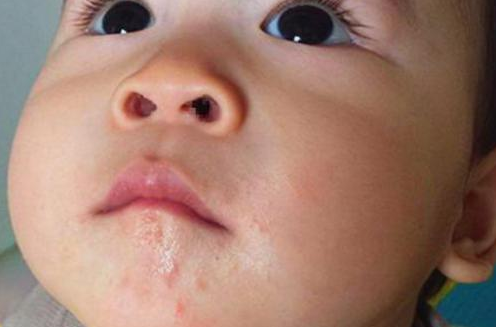 宝宝嘴巴周围起红疹是怎么回事 宝宝嘴巴周围长红疹怎么办